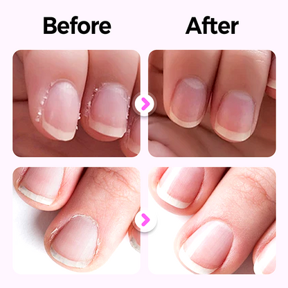 💜 Kaufe 1 und erhalte 1 gratis 💜2025 Neuer und verbesserter 3-in-1-Nagelpflegestift.